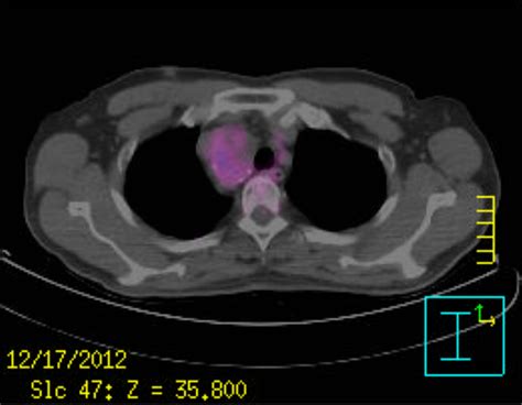 A Case Of Right Paratracheal Ectopic Thyroid Mimicking Metastasis On
