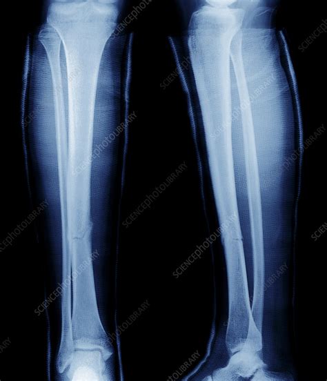 Fractured Shin Bone X Ray Stock Image M3301358 Science Photo
