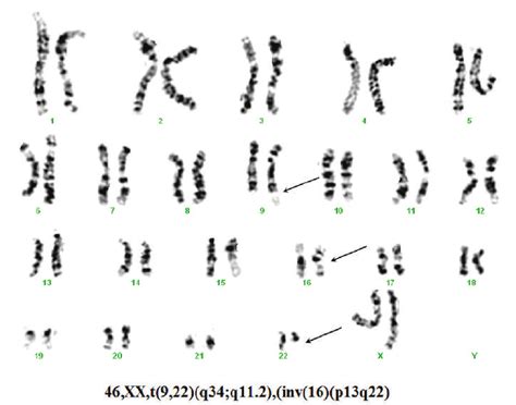 G Banded Karyotype Of Bone Marrow Cells Showing The Coexistence Of The