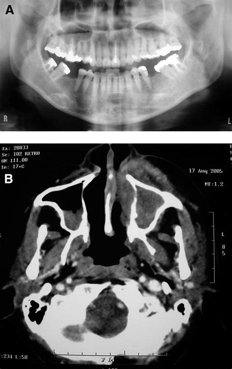 Palatal Ulcerations And Midfacial Swelling Oral Surgery Oral