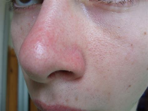 Blackheads Causing Extreme Redness On Nose General Acne Discussion