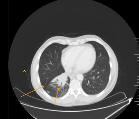 Bronchogenic Carcinoma Ct Chest Sumers Radiology Blog