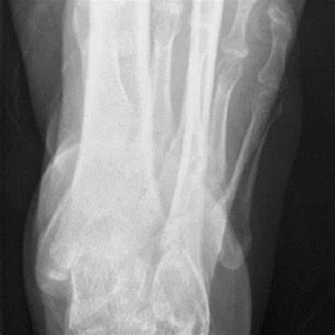 The Stephens And Sanders Classification System Of Calcaneal Malunion