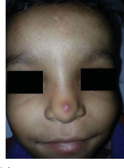 Pdf Nasal Tip Dermoid Sinus Cyst Excision By Open Rhinoplasty