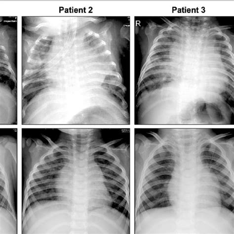 Chest Radiographs Of The Four Patients Enrolled In The Study Showing
