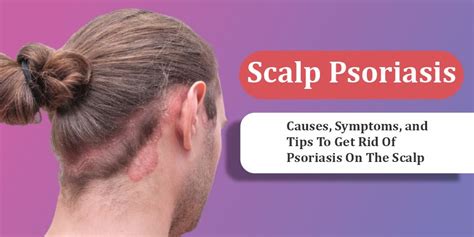 Scalp Psoriasis Treatment Just Finder