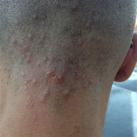 What Can I Do For These Bumps On The Back Of My Head Back Body Neck