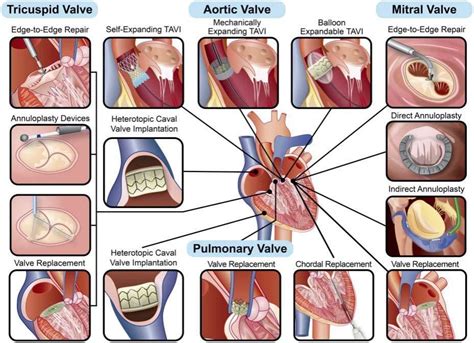The Year In Cardiology 2019 Valvular Heart Disease