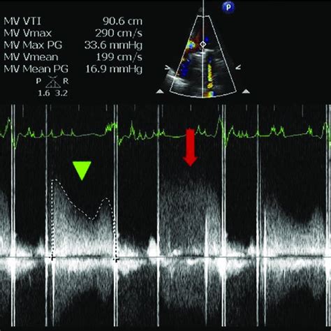 Continuous Wave Cw Spectral Doppler Through The Mechanical Mitral