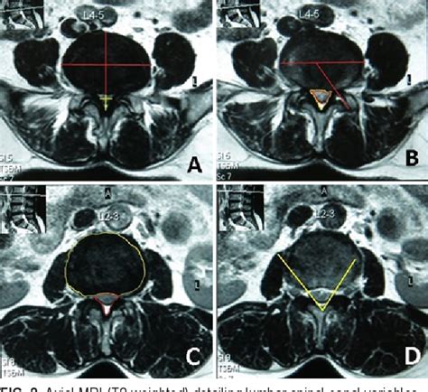 figure 2 from redefining lumbar spinal stenosis as a developmental syndrome an mri based
