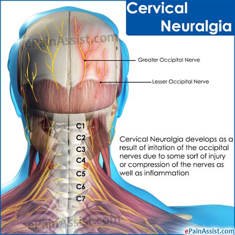 Cervical Neuralgia Causes Symptoms Treatment Diagnosis