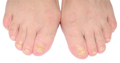 Fast Effective Tool To Diagnose Nail Fungus Dermatology Times And