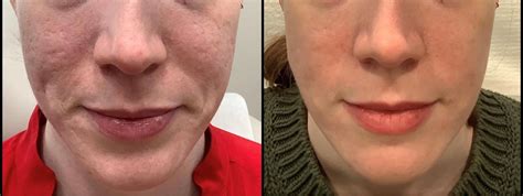 Genius Rf Microneedling Before And After Photos Patient 43 Washington