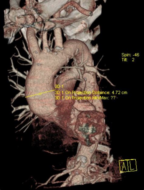 Safe Wrapping Of The Borderline Dilated Ascending Aorta During Aortic