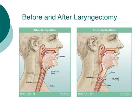 Ppt Tracheoesophageal Puncture Voice Prosthesis Tep Vp And Speaking