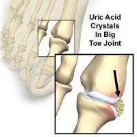 Learn about eight natural ways to lower uric acid levels in this article. Uric Acid - The Cause Of Gout Pain? Be Done With It.