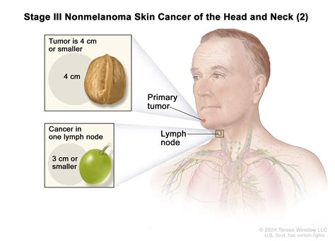 Early Stage Cancer Lymph Nodes In Neck Allthingspoliz