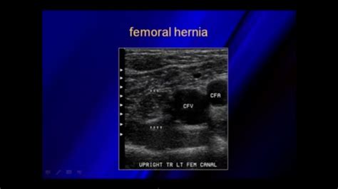 Ultrasound Of Hernias Ultrasound Fem Canal