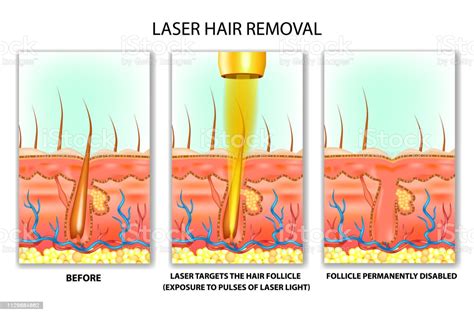 Laser Hair Removal Stock Illustration Download Image Now Istock
