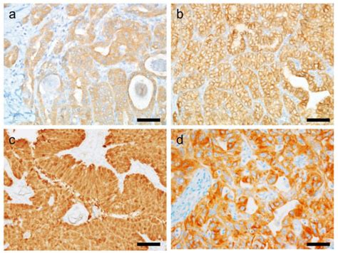 Cancers Free Full Text Emerging Biomarkers In Thyroid Practice And