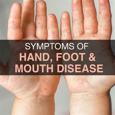 Hand Foot And Mouth Disease Everything You Need To Know About It
