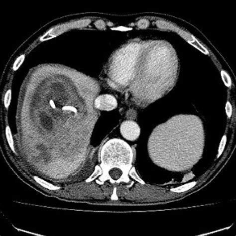Abdominal Ct Scan With Contrast Agent Performed 7 Months After