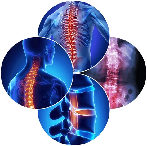 Revision Spine Surgery Advanced Neck And Back Relief