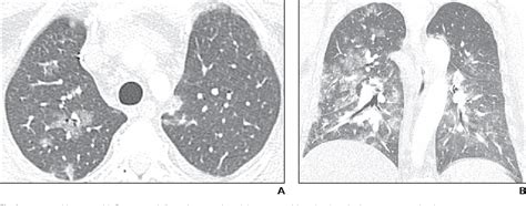 Pdf Pneumocystis Jiroveci Pneumonia High Resolution Ct Findings In
