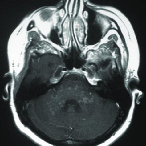 Kamışlı ö, tecellioğlu m, erbay mf, kamışlı s, özcan c. (PDF) Un cas de « CLIPPERS » guéri par immunothérapie cinq ...