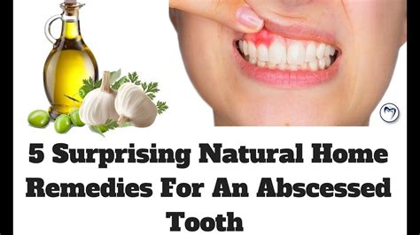 Tooth Abscess Homeopathic Treatment