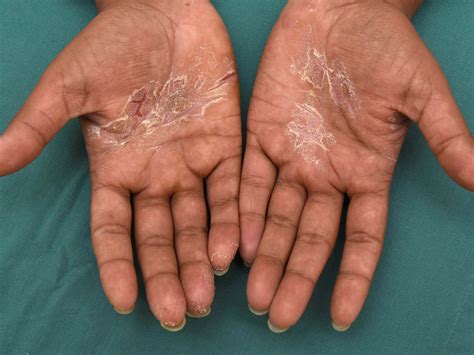 Hand Eczema About And Treatments Eczema Org