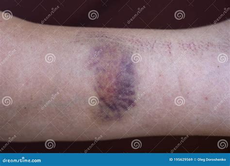 Purple Bruise On The Skin On A Woman Hand Stock Image Image Of Human