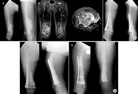 A A Preoperative Images Showing Distal Femoral Lesion Osteogenic