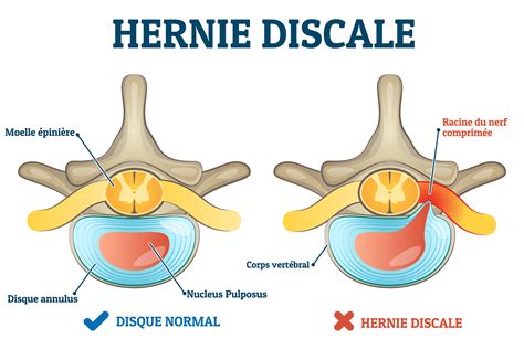 Hernie discale calcifiée ou molle diagnostic et traitements Information hospitalière
