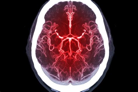 Toward A Better Understanding Of Sex And Gender Related Differences In Endovascular Stroke