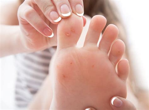 How To Care For Your Plantar Warts Freeland Foot And Ankle Clinic