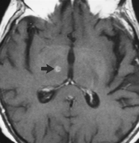 Mr Imaging Findings After Stereotactic Radiosurgery Using The Gamma