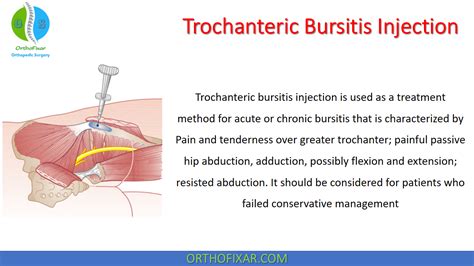 Trochanteric Bursitis Injection Technique