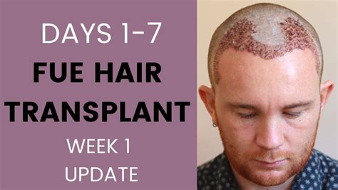 Top 145 1 Week Post Hair Transplant Polarrunningexpeditions