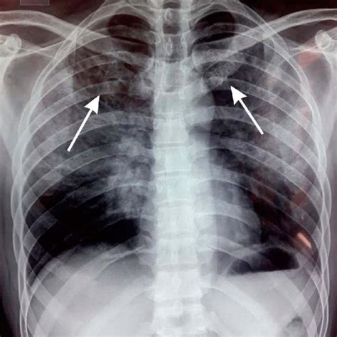 Chest X Ray Shows Bilateral Infiltrates And No Cardiomegaly Left And