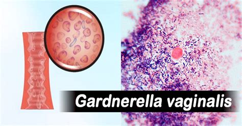 Habitat And Morphology Of Gardnerella Vaginalis Microbiology Notes
