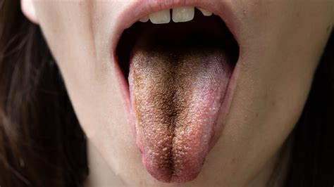 What Is Black Hairy Tongue