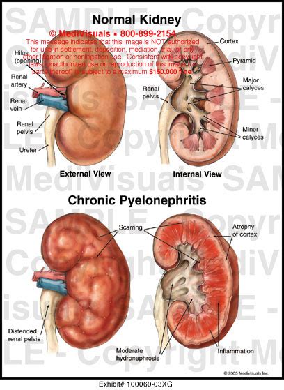 Chronic Pyelonephritis Medical Illustration Medivisuals