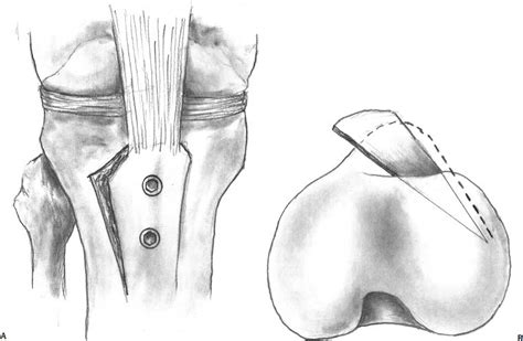 Surgical Management Of Patellofemoral Disease Musculoskeletal Key