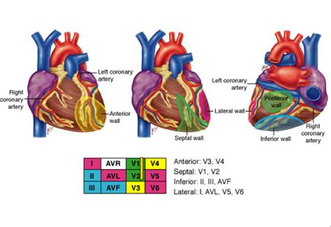 Coronary Arteries And Correlating Ecg Leads In Mi Coronary Care