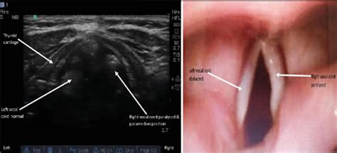 Assessment Of Functionality Of Vocal Cords Using Ultrasound Before And