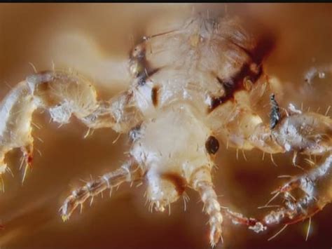 Super Lice Found In 25 Us States
