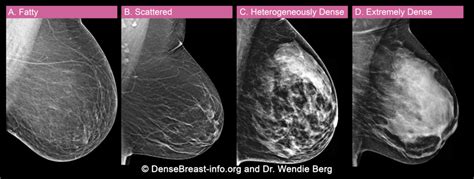Dense Breasts Answers To Commonly Asked Questions Nci