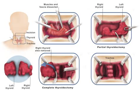 Thyroid And Parathyroid Surgery