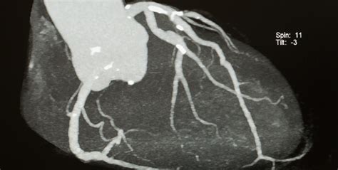 Cardiac Imaging Baylor Radiologists A Radiology Partners Affiliated